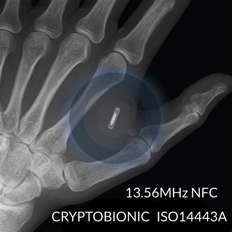 nfc tag implant buy|nfc implants for sale.